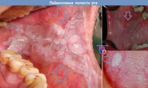 4 типа лейкоплакии полости рта