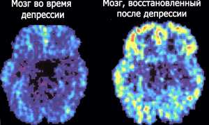 Причины, симптомы и методы лечения маниакальной депрессии