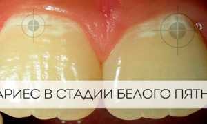 Лечение начального кариеса без бормашины