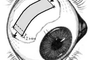 Склеропластика глаз: что это такое, цена, отзывы, видео