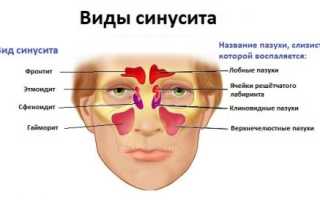 Лечение хронического синусита, его причины и симптомы