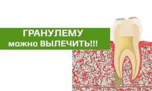 Опасность гранулемы корня зуба и способы лечения