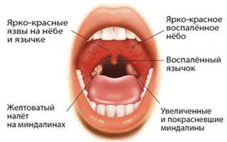 Признаки абсцесса при ангине и методы его лечения