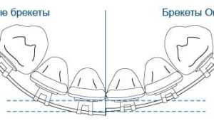 5 преимуществ использования брекетов Orthos