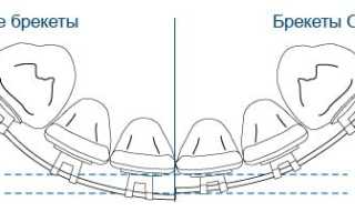 5 преимуществ использования брекетов Orthos