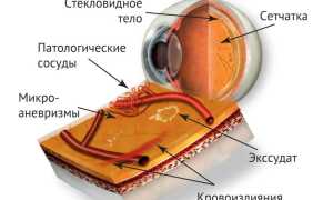 Ретинопатия у недоношенных, при диабете, посттромботическая: причины, симптомы, лечение