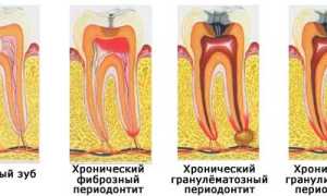 Популярные антибиотики для лечения периодонтита