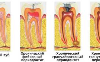 Популярные антибиотики для лечения периодонтита
