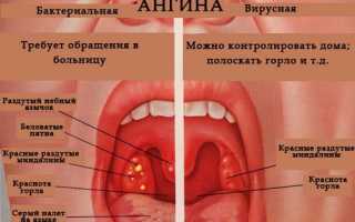 Лечение стафилококковой ангины в домашних условиях