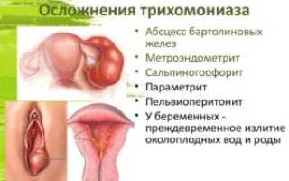 Чем опасен трихомониаз для женщин и для мужчин?