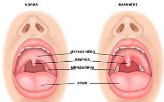 Как выглядит здоровое горло и диагностика воспаления