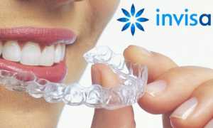 Элайнеры Invisalign как достойная замена брекетам