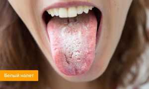 На какие проблемы указывает белый налет на языке