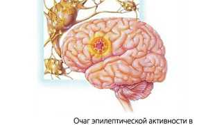 Симптомы фокальной эпилепсии, диагностика и лечение