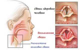 Что такое хронический ларингит и методы его лечения