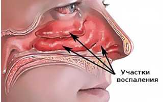 Как вылечить хронический насморк