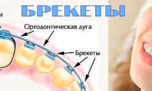 Пилот — проверенная временем брекет-система для исправления аномалии прикуса