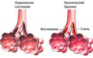 Бронхит: симптомы и лечение, причины заболевания и осложнения