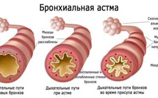 Как остановить астматический кашель, его причины и симптомы