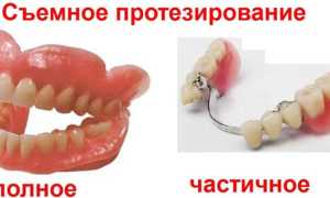 Как жить красиво со вставной челюстью