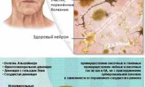 Причины развития и профилактика при болезни Альцгеймера