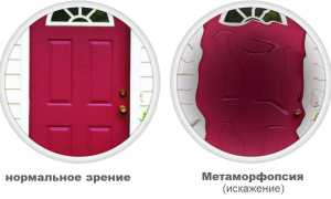 Виды, симптомы и лечение метаморфопсии