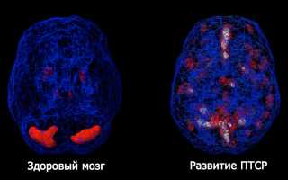 Причины, признаки, диагностика и лечение посттравматического стрессового расстройства