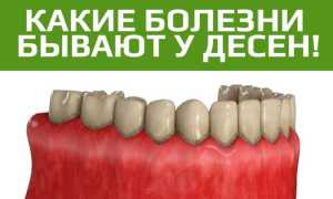 5 самых распространенных болезней десен