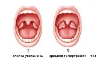 Лечение воспаления миндалин в горле у взрослых и детей