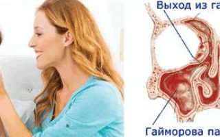 Первые признаки и симптомы гайморита