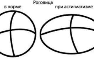 Астигматизм — что это такое, как его лечить?