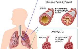 ХОБЛ: причины, симптомы, лечение хронического обструктивного бронхита