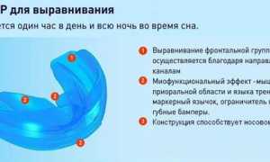 Исправляем прикус без брекетов – реально или нет?