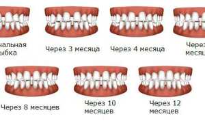 Сроки ношения брекетов и отчего они зависят