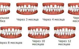 Сроки ношения брекетов и отчего они зависят