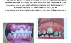 Диагностика и лечение гиперплазии десен