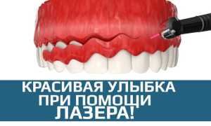 Виды гингивэктомии для спасения десен